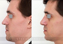 Фото до и после ринопластики, хирург Глушко Александр Витальевич