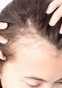 15 факторов, почему женщины теряют волосы