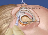 Пластика ушей: как проводится операция