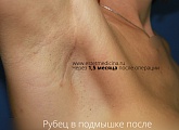 Рубец в подмышке после увеличения груди 1,5 месяца