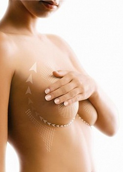 Хирургическая подтяжка груди, мастопексия: видео