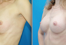 Блохин Сергей Николаевич, увеличение груди через подмышку до и после 2