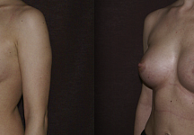 Салиджанов Анвар Шухратович, увеличение груди до и после 4