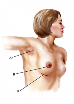 Доступы при увеличении груди