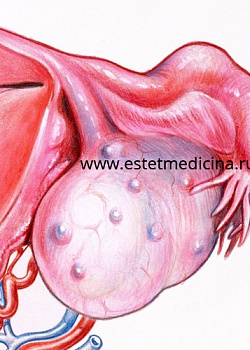 Киста яичника: операция или гормональная терапия? Мнение врачей