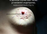Ареолярная подтяжка на имплантах груди: результат