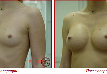 Якимец Валерий Григорьевич, увеличение груди до и после 15