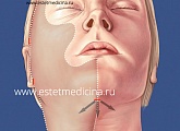Разрезы при эндоскопии лба и средней зоны лица при омоложении пациента с большим избытком тканей с примененим платизмопластики