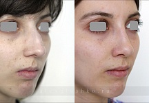 Фото до и после ринопластики, хирург Глушко Александр Витальевич