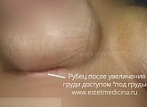 рубец после увеличения груди доступом под грудью фото
