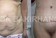 Бакирханов Сарвар Казимович, абдоминопластика фото до и после 1