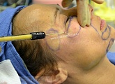 Липофилинг лица фото процедуры