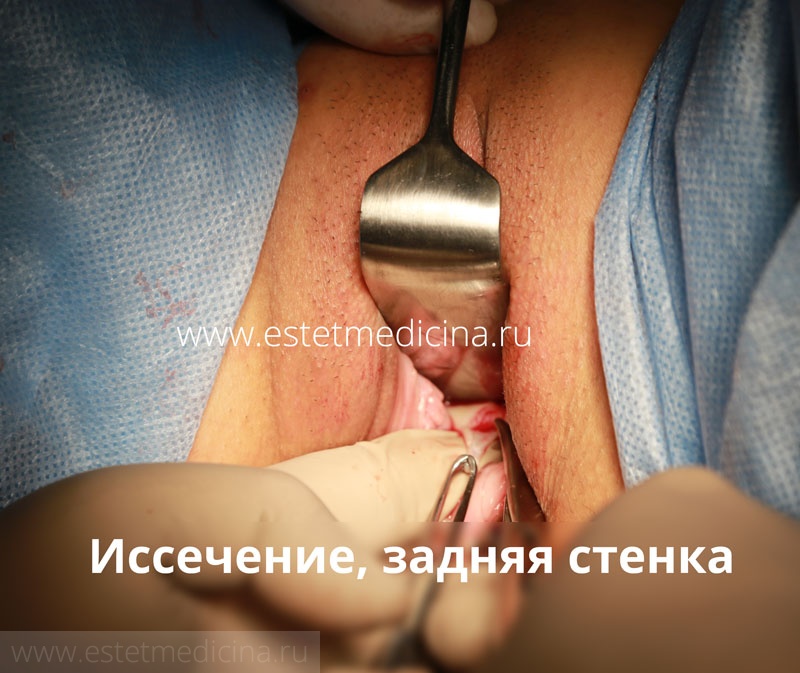 Пластика влагалища (вагинопластика) в Москве по выгодной цене в платной клинике