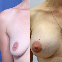 Кобулашвили Тимур Гивиевич, увеличение груди фото до и после