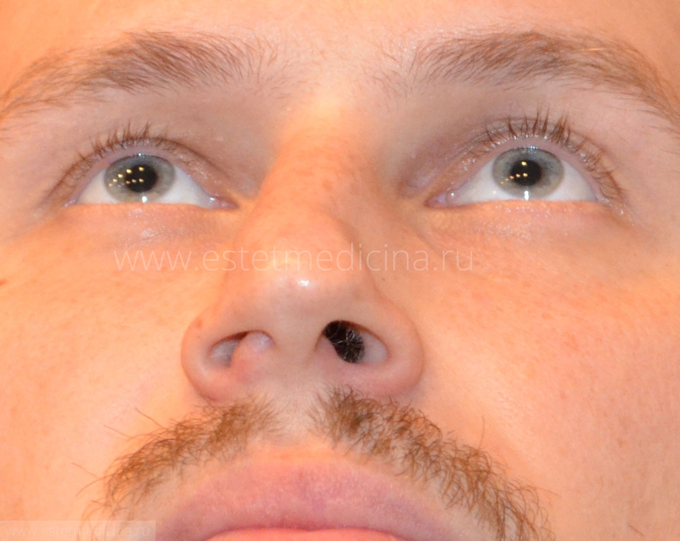 Перелом носовой перегородки