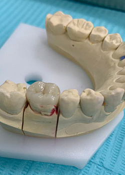 Виды несъемного протезирования зубов