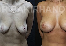Бакирханов Сарвар Казимович, увеличение груди фото до и после -5