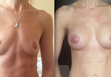 Установлены импланты Аллерган ff, объем 315, доступ - через ареолу. Двое родов, грудное вскармливание. Обратилась из-за недостаточного объема и субинволюции, птоз, опущение, эстетическая неудовлетворенность своим телом. Фото «после» сделано через 1,5 мес
