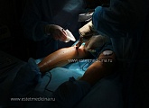Операция круропластика: разрез и формирование ложа для протеза