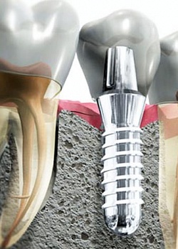 Какие зубные импланты лучше? Мнение врачей