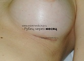 Рубец под грудью через месяц после операции по увеличению груди имплантами