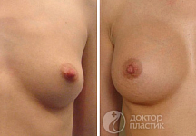 Сергеев Илья Вячеславович, увеличение груди до и после 1